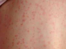 In cazul in care copilul nu a fost vaccinat impotriva virusului si are rubeola, este important sa nu. Complicatii Rujeola