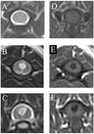 Image result for Syringomyelia