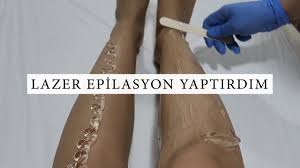 Lazer Epilasyon Acitiyor Mu Uygulamali Anlatim Youtube