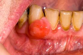 Image result for granuloma gum disease