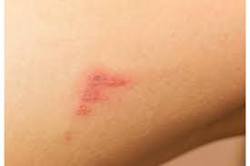 In aproximativ o saptamana, eruptia va disparea, iar copiii se vor simti mai bine. Pe Pielea Copilului Au Aparut Mici Bubite Rosii Ar Putea Fi Impetigo