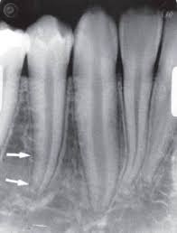 Chụp phim cận chóp bằng kĩ thuật phân giác cho vùng răng cửa hàm dưới