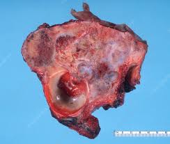 Image result for Chondrosarcoma