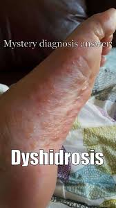 Image result for dyshidrosis