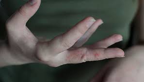 Image result for scabies human bites