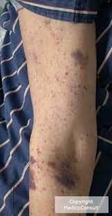 Wer rettet den „retter der mütter? Sepsis Facharztwissen