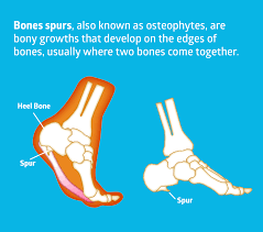 How to tell its bone spur and nothing else? How To Treat Bone Spurs The Natural Way Algaecal