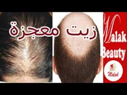 زيت لعلاج الصلع في مقدمة الرأس والثعلبة وانبات الفراغات فى اسبوع والله مجرب مع ملك Youtube