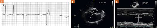 Pimobendan And Heart Disease Todays Veterinary Practice