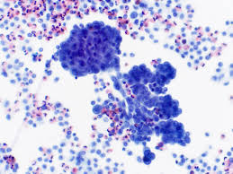 Malignant pleural mesothelioma (mpm) is an aggressive malignancy arising from mesothelial cells lining the pleura. Momin Siddiqui Twitterren Right Pleural Fluid From A 64 Year Old Male With Pleural Thickening Bland Appearing Mesothelial Cells With Numerous Macrophages In The Background Yes This Is A Malignant Mesothelioma Which