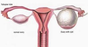 Ovarian Cysts Are Fluid Filled Sacs Or Pockets That Develop Within Or On The Ovarian Cyst Treatment Ovarian Cyst Cyst On Ovary