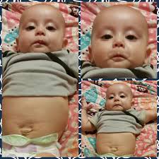 From Guts to Glory: Kain's Journey with Gastroschisis