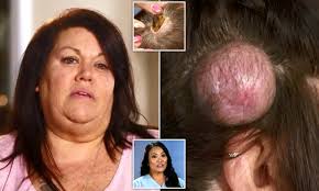 Are videos of people removing blackheads repulsive or fascinating? Woman Who Has Ten Large Cysts On Her Scalp Gets Them Removed In Dr Pimple Popper Daily Mail Online