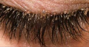 You Do Have Mites In Your Eyelashes And Here Is What You Must Do With Use Of Lavender Essential Oil Eyelash Mites Eye Mites Eyelashes