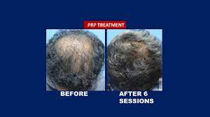 Application process at universities in malaysia. Prp Treatment Hairtransplantcentremalaysia Com