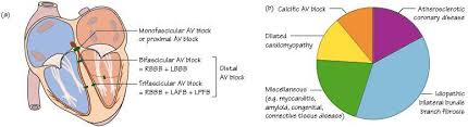 Image result for Atrioventricular Block