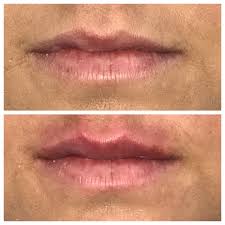 Medical aesthetics to include skin care, botox and filler injections; Anna Stephens Aesthetics In Ruston La Styles Vagaro