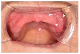 Image result for oral herpes symptoms roof of the mouth