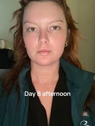 Days After A Gull Face Surface Laser