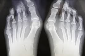 Image result for XRay Changes in Rheumatic Conditions