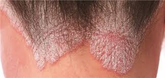 Plaque psoriasis is the most common type affecting approximately 90% of psoriasis sufferers. Psoriasis Kommt Selten Allein