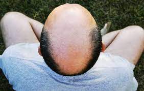 It is something that occurs on a gradual basis, which often makes it thinning hair can often occur after you have had a baby or stopped taking birth control. 7 Ways To Stop Hair Loss Treatments And Prevention