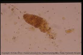 Image result for Urinary Cast