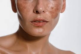 Image result for Hyperpigmentation