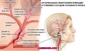 Cuzhenie Sosudov Golovnogo Mozga Simptomy Lechenie I Posledstviya