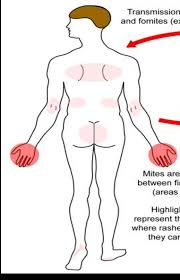 Image result for scabies transmission
