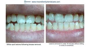 Feb 24, 2021 · most people do not experience pain when getting their braces removed. White Spots After Braces Removal Braces Removal After Braces Braces