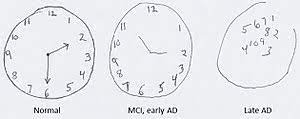 1 point for the clock circle. Montreal Cognitive Assessment Wikipedia
