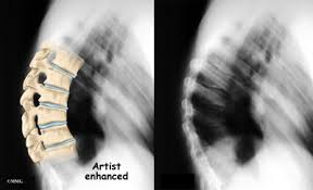 Multiple and contiguous involvement of vertebral bodies, the anterior wedging, antero posterior elongation. Scheuermann S Disease Orthogate