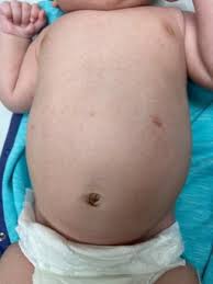 Image result for Urticaria pigmentosa children