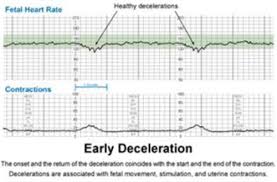 Image result for Early Deceleration