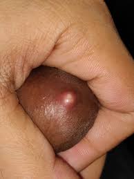 When one has got a lot of ingrown hairs, they may be itchy and uncomfortable. Pimple Ingrown Hair What Is This On My Penile Shaft Penis Disorders Forums Patient