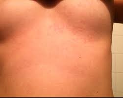 Image result for heat rash under breasts