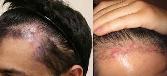 Also, your hair on scalp can become ingrown by themselves. Ingrown Hair On Head Scalp Pictures Symptoms Removal Treatment