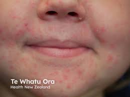 Image result for dermatitis contacta children