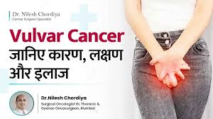 Image result for Vulvar Cancer