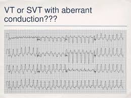 Vt versus svt • litfl medical blog • ecg library basics. Advanced Ecgs