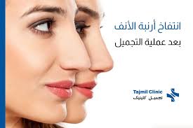 انتفاخ أرنبة الأنف بعد عملية التجميل | تجمیل کلینیک