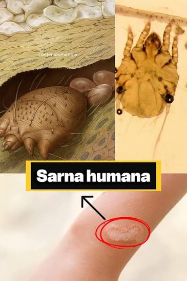 La sarna es una condición de la piel causada por ácaros, que se puede  propagar rápidamente entre las personas que están en contacto físico  cercano. Puede causar picazón intensa y una erupción