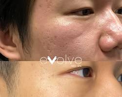 microneedling with prp before and after results faces, AI generated
