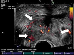 Skip to content search menu this is cancer.net's guide to prostate cancer. Applications Of Transrectal Ultrasound In Prostate Cancer Abstract Europe Pmc