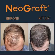 6 to 30 characters long; Bhtc Buffalo Hair Transplant Center Is The Leader In Hair Restoration And Non Scaring Transplant