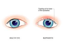 The main treatment for blepharitis is regularly cleaning your eyelids and keeping them free of crusts. Blepharitis Causes And Treatment Fort Lauderdale Eye Institute