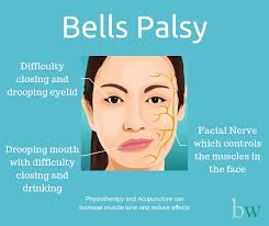 The onset is sudden and symptoms typically peak within a few days. Face Drop Bell S Palsy The Bodyworks Clinic Marbella Spain