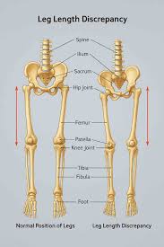 Image result for Functional Leg Length Discrepancy