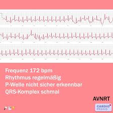 Dieses oft grundlose aufgeregtsein begleitet einige menschen permanent, bei anderen. Herzrasen Plotzlicher Schneller Herzschlag Cardiopraxis